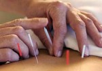 acupuntura-em-embu-das-artes-1441056267