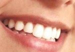 implantes-dentarios-em-embu-das-artes-1441062708